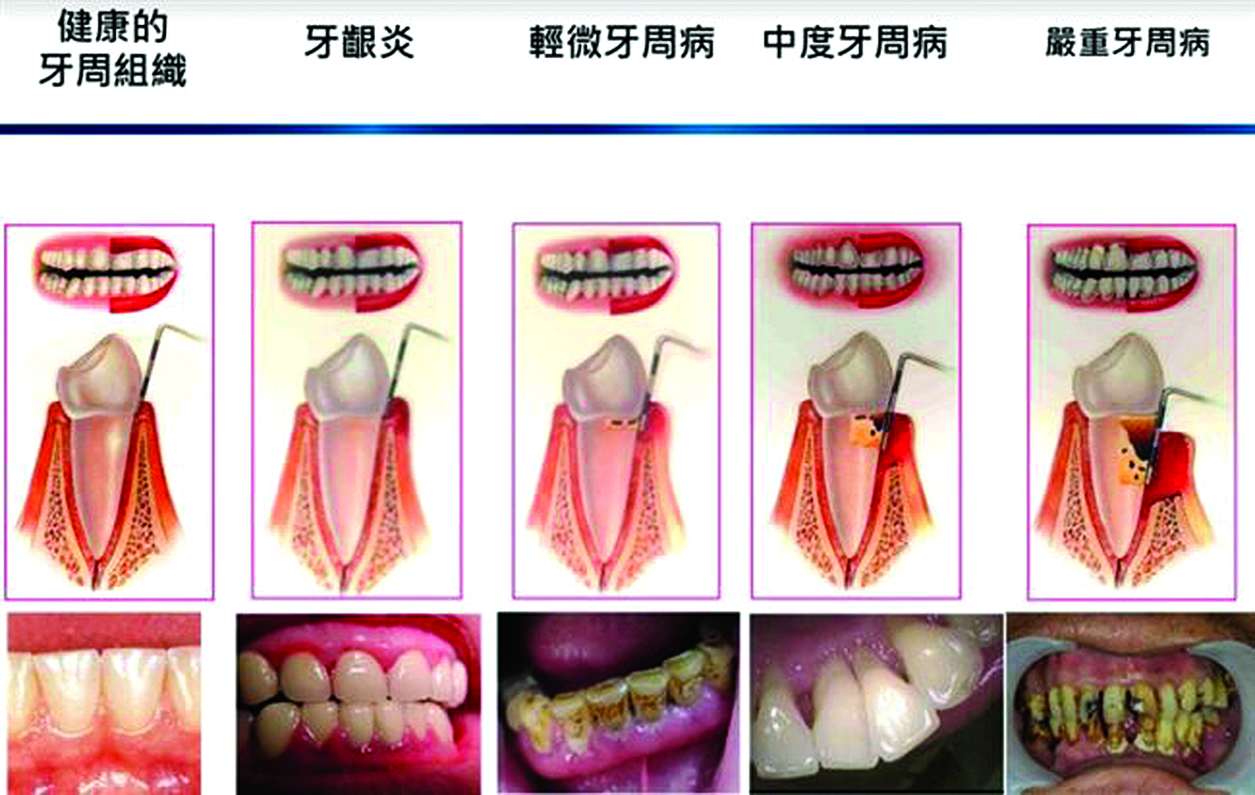 牙龈癌早期症状图片(55)_有来医生