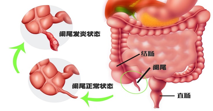饭后运动,会得阑尾炎?真相是这样…… - 健康时尚 Good Health